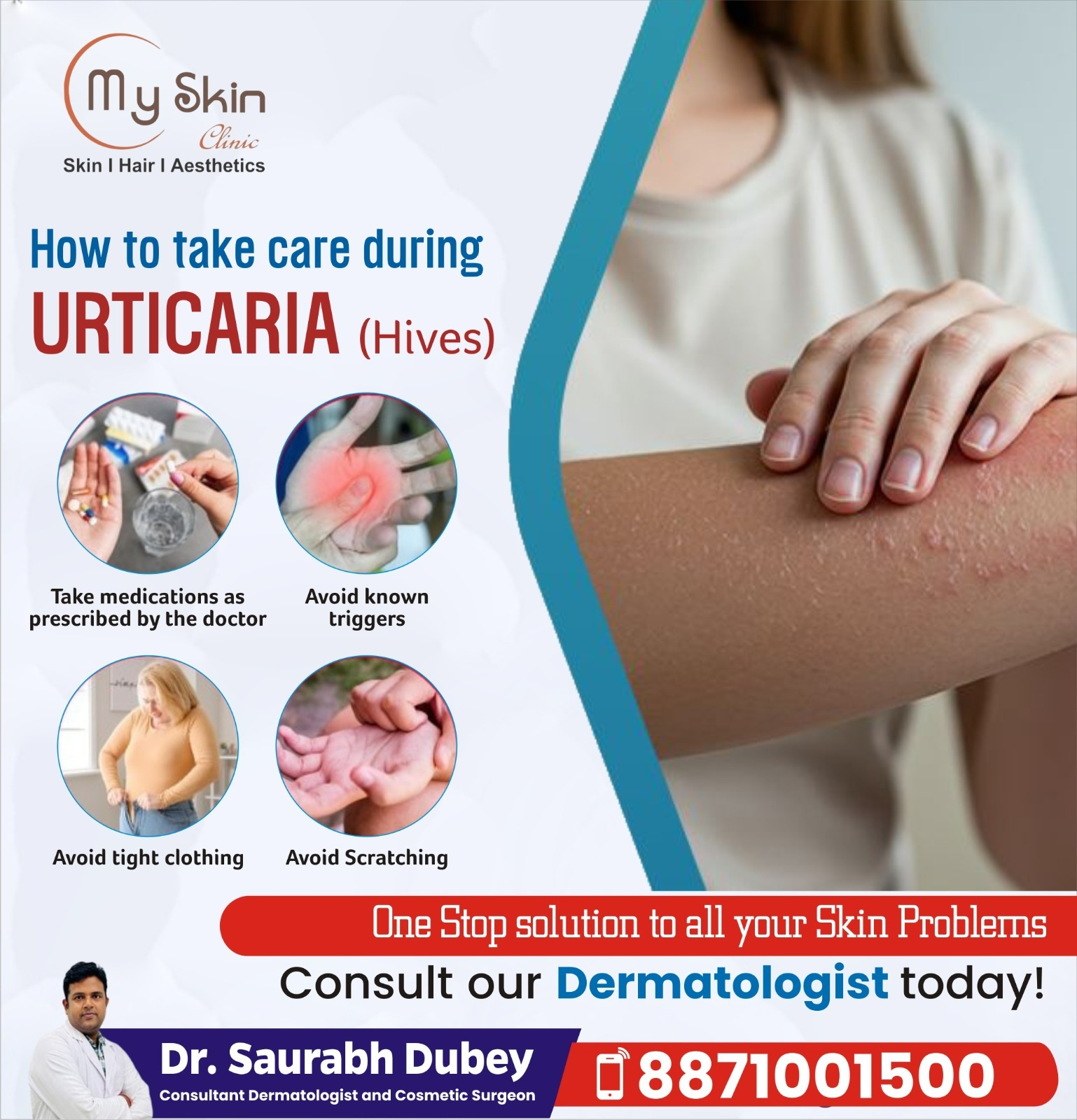 Best Hives Treatment Specialist in Indore